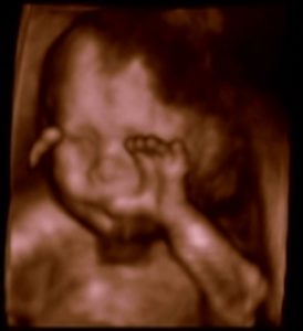 3D & 4D Sonography